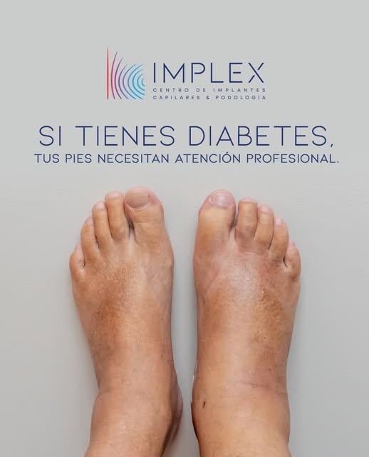 ¿Tienes diabetes? Entonces esto te interesa. 👣

Tus pies pueden estar diciéndote cosas que quizá no