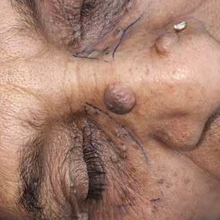 Remove Eyelid Fat permanantly.