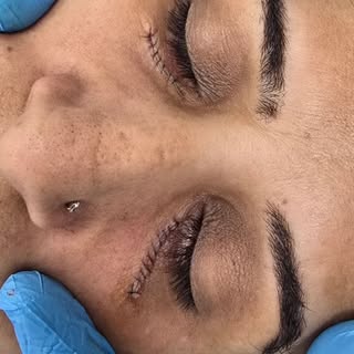 Xanthelesma (Eyelid fat deposit) surgery.