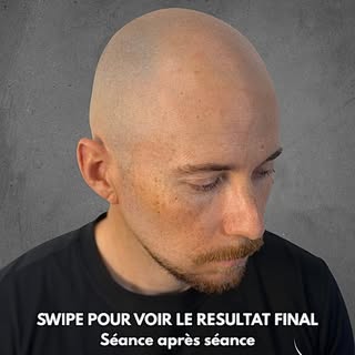 La tricopigmentation est un traitement qui se construit, elle ne s’improvise pas.

Sur ce post, vous