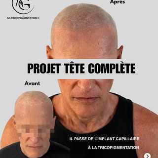Deux greffes capillaires non concluantes. Un complément capillaire porté chaque jour pendant 20 ans.