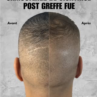 Le camouflage de cicatrice post greffe de cheveux FUE est une pratique courante en micropigmentation
