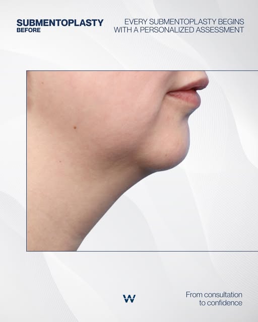 When under-chin fullness softens the jawline, the right surgical approach can redefine the entire pr