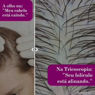 O que parece apenas uma queda comum a olho nu, na verdade pode ser o início do afinamento capilar (m