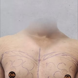 Bilateral Gynecomastia Before & After Result🔥

Minimal scarring and quick recovery highlight the pr