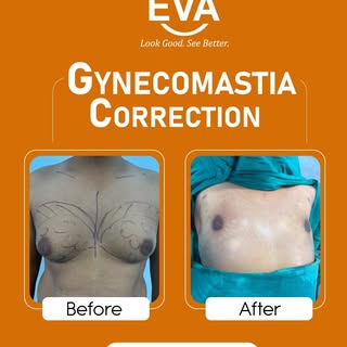 Before → After | Gynecomastia Transformation

A more defined chest. A more confident you.
See the di