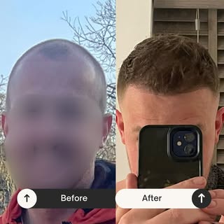 Is it a hair transplant or a Time Machine? Either way, we have a new man! #hairtransformation #hairt