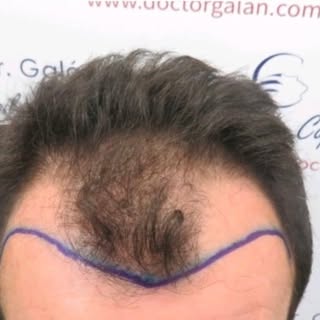 👩🏻‍🦲 Injerto Capilar 2990 FUE Grafts.

👨 Varón 49 años sin antecedentes. NW IVMP.
Se plantea una