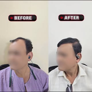 Wait for the final result… this one speaks for itself
#HairTransplantResults #TransformationReel #Ha