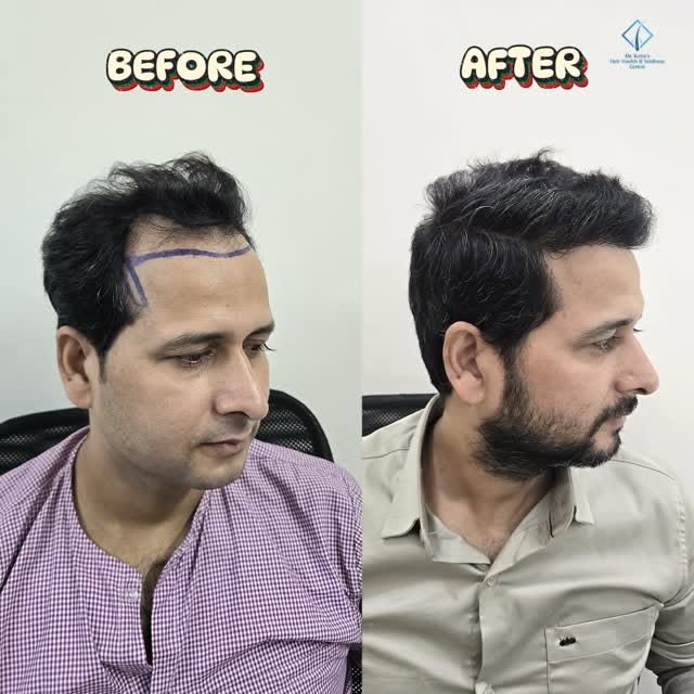 Before tha struggle, after hai confidence.
Natural result, clean look, full glow-up
No hair → Full h