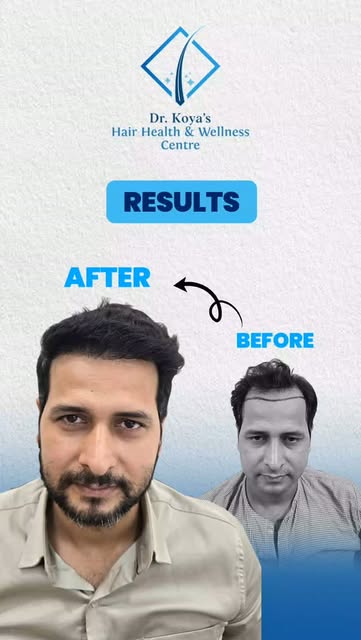 From concerns about hair loss to seeing visible improvement. Hear it directly from our patient.

Rea