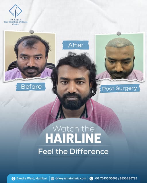 Your journey to a better hairline starts here.

📍 Bandra West, Mumbai
📞 Book your appointment toda