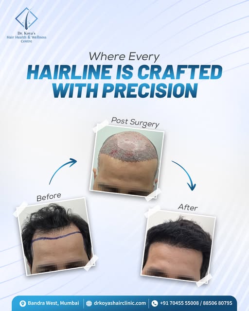 A great hair transplant isn’t just about adding hair. It’s about creating a natural-looking hairline