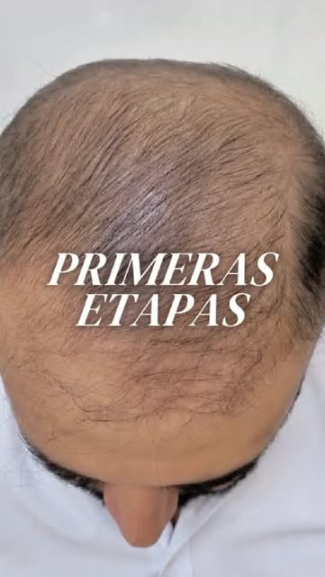 Recuperar tu cabello sí es posible… cuando usas la tecnología correcta.

✨ Resultados que reflejan c