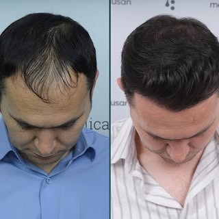 @drsibelulusan  #saçekimi  #sacekimisonucları  #saçekimiizmir  #hairtransplant
