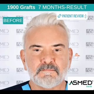 Dr Koray Erdoğan hocamızın 7 aylık saç ekimi sonucu. #drkorayerdogan #asmed #dilekçakır #hairtranspl