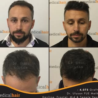 Dr Sibel Ulusan www.sacekimisonuclari.com sadece Saç ektiren insanların saç ekimi sürecini paylaştığ