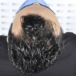 #sacekimiistanbul #sacekimiforum #sacekimisonucları #hairtransplant #hairtransplantturkey #hairtrans