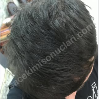 ASMED KORAY ERDOGAN 26.9.2022 ‘KE BOT’ 2210 greft Fue saç ekimi süreci saç ektiren üyemiz tarafından
