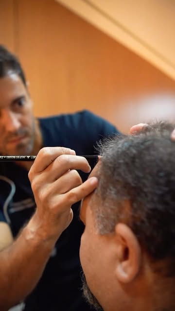 Nosso paciente, de 59 anos, iniciou hoje seu procedimento de transplante capilar, com todo acompanha
