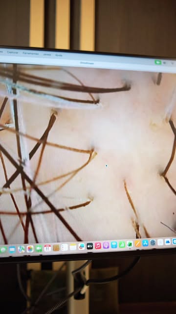 Tricoscopia de acompanhamento — 1º mês de pós-operatório

Nessa fase, o couro cabeludo já mostra:

�