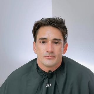Essa paciente fez um peeling profundo porque as cicatrizes eram fundas.
Após a recuperação, tivemos 
