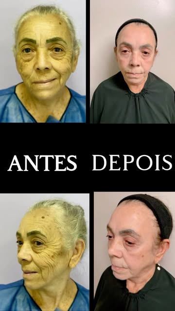 ✨ REJUVENESCIMENTO FACIAL AVANÇADO ✨

A paciente realizou o BioLift Regenerativo Facial, técnica que