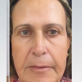 ✨ RESULTADO REAL ✨

BioLift Regenerativo Facial: rejuvenescimento natural, melhora das rugas, flacid