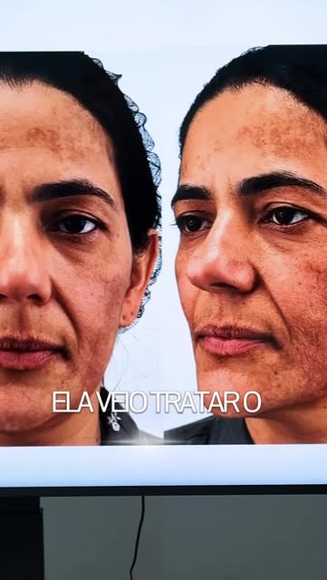 Esta paciente foi submetida ao BioLift Regenerativo Facial.

Um procedimento inovador que promove re