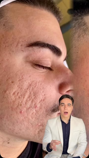 Tratamento para cicatrizes de acne.

Se você tem cicatrizes de acne e deseja melhorar a aparência da