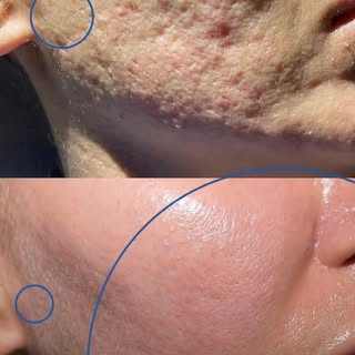 Você tem cicatrizes de acne e elas ainda te incomodam?

Existe um tratamento chamado BioLift Regener