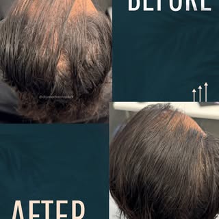 We’re thrilled to share the amazing results our patient is experiencing with the HRP™️ (Hair Restora