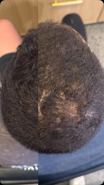 3 months into his HRP™ hair restoration journey.

This gentleman in his 30s presented with male patt