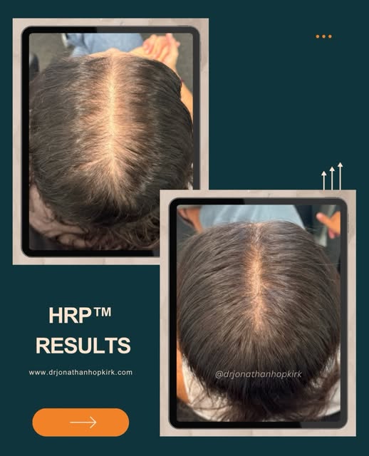 6 months into her HRP™ hair restoration journey.

This patient presented with female pattern hair lo