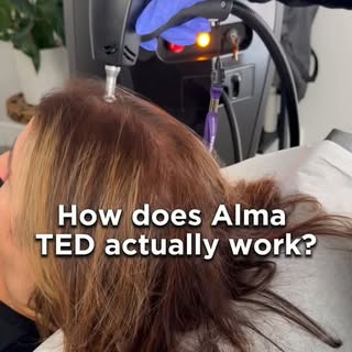 Wondering how Alma TED supports hair restoration? 🤍
Alma TED uses ultrasound technology and air pre
