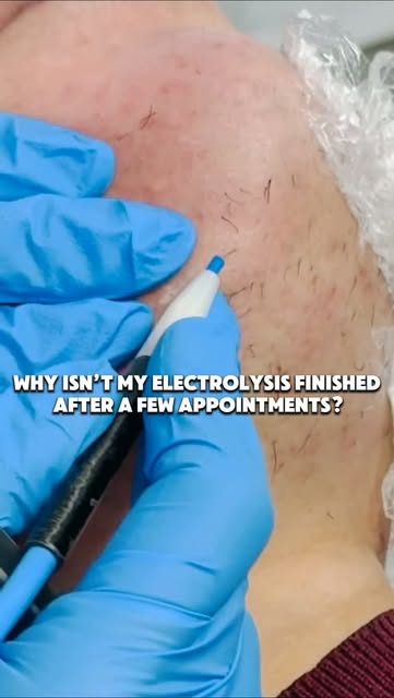 A few appointments in and still seeing hair? That doesn’t mean electrolysis isn’t working. 🤍
Perman