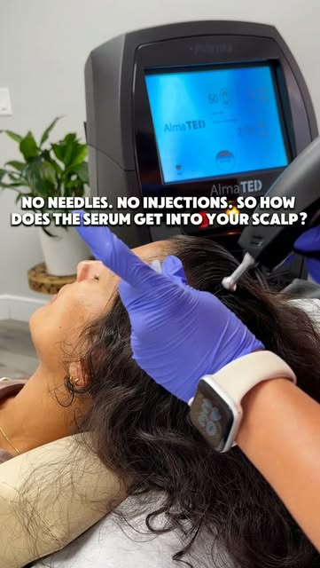 No needles. No injections. So how does Alma TED actually deliver the formula to the scalp? 👀
Alma T