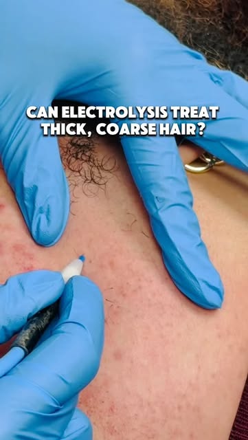 Thick, coarse hair can feel like the most stubborn hair to get rid of but electrolysis can treat it.