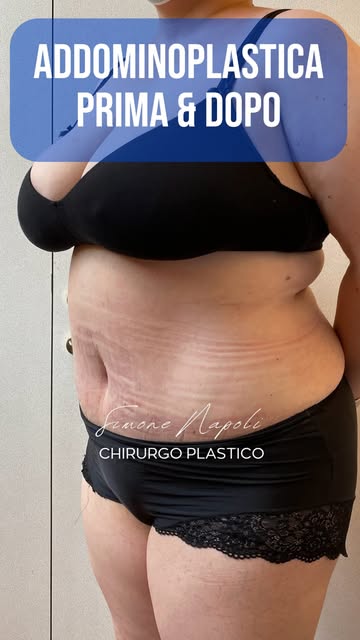 Non tutti gli addomi possono migliorare con dieta e attività fisica.

Quando sono presenti un import