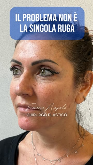 Un Full Face ben progettato non significa cambiare un volto.
Significa riequilibrare i diversi eleme