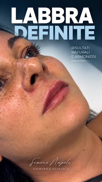 Un risultato armonioso non significa semplicemente aggiungere volume.
Il filler labbra deve rispetta