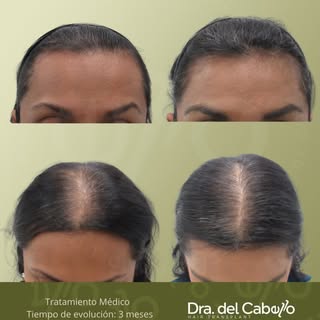 Sé lo difícil que puede ser la caída de cabello .. 🍂, pero también sé que si hay soluciones 💫. Aqu