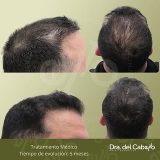 Con el tratamiento médico capilar adecuado, es posible recuperar la salud, densidad y apariencia del