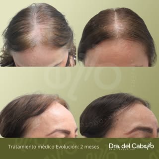 Más densidad 🌱, más confianza 🙌🏻 
.
Resultados reales que transforman no solo el cabello, sino ta