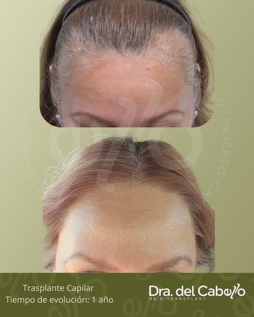 Trasplante capilar 🌱 + 1 año de paciencia, constancia y compromiso = un resultado natural ✨🤩
.
Rec