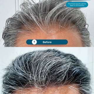 6 months: The stage of transformation. ⏳

Halfway through the journey, the results are already evide