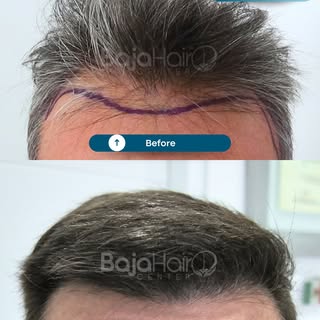A fuller look from the front to the crown. ✨

This transformation focuses on restoring hair density 