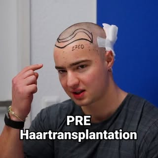 Der erste Schritt zur Haartransplantation!
.
.
#hairmedic #prehaartransplantation