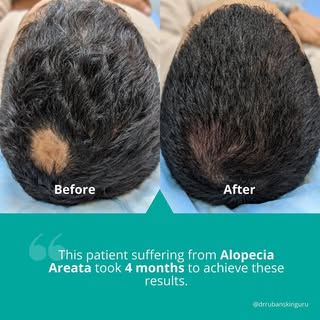 Alopecia Areata is a condition that causes hair to fall out in small patches. The condition develops