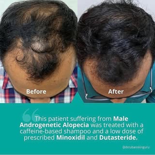 This patient who was suffering from Male Androgenetic Alopecia (Male Pattern Hair Loss) was treated 